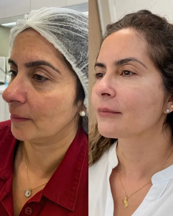 Antes e depois de rejuvenescimento facial