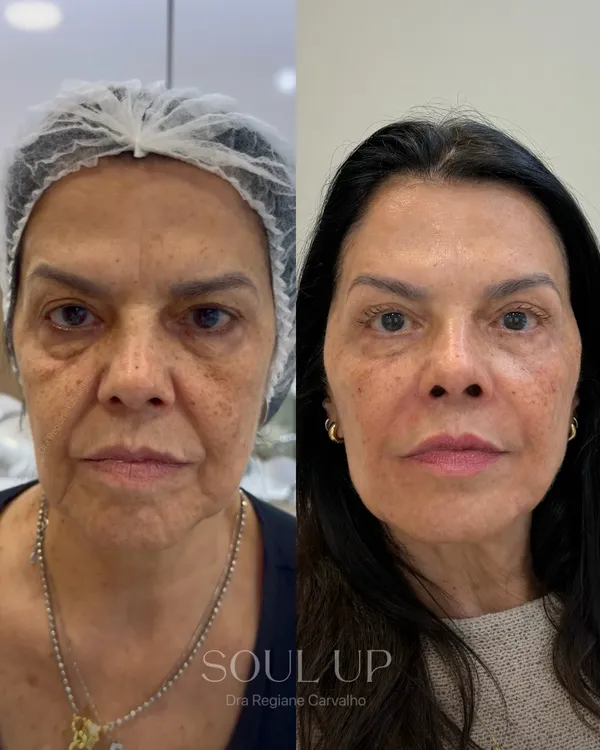 Antes e depois com protocolo Soul Up