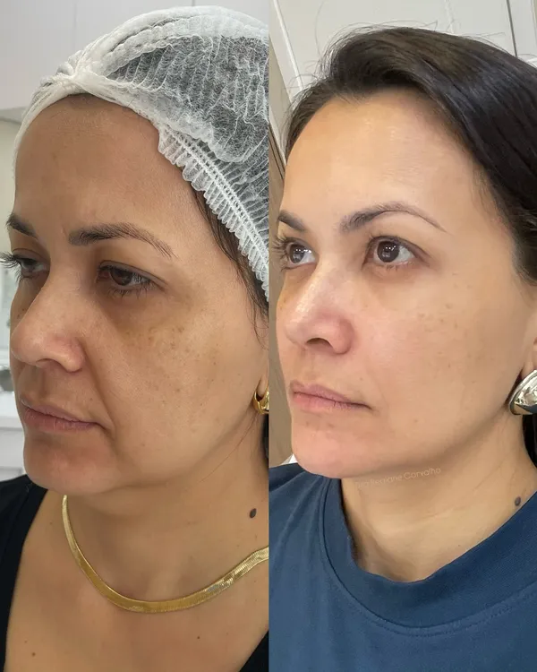 Antes e depois de reestruturação facial