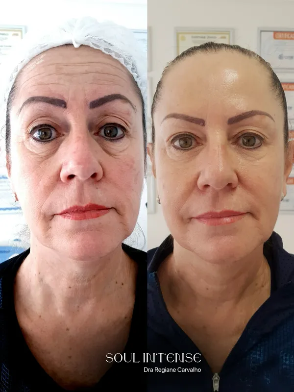 Antes e depois com protocolo Soul Intense