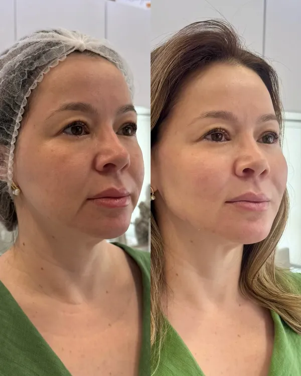 Antes e depois de processo de rejuvenescimento